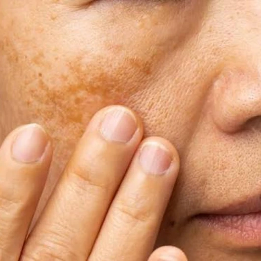 Menopausal Skin